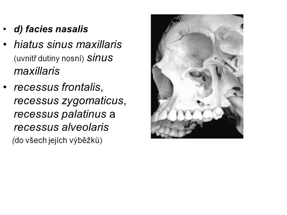 hiatus sinus maxillaris (uvnitř dutiny nosní) sinus maxillaris