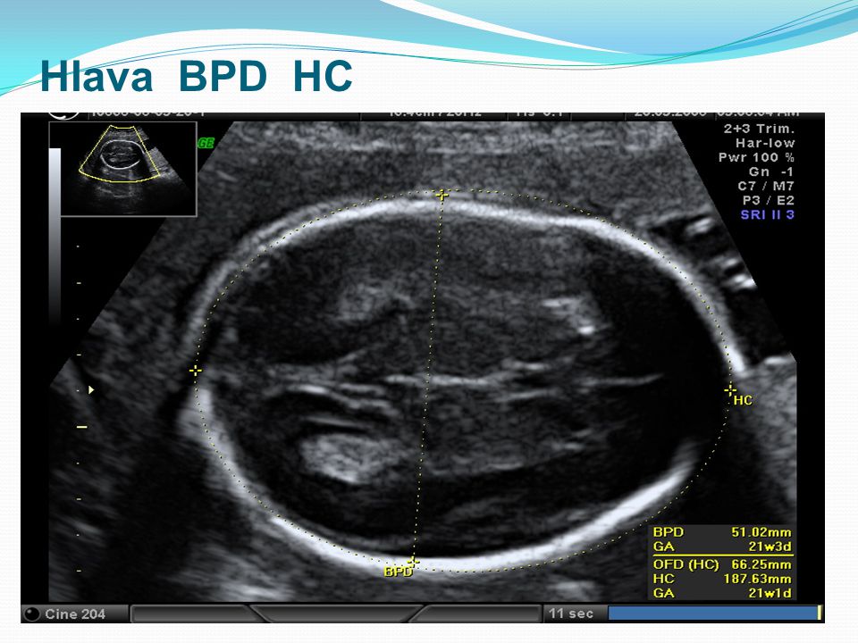 Datování ultrazvuk postup