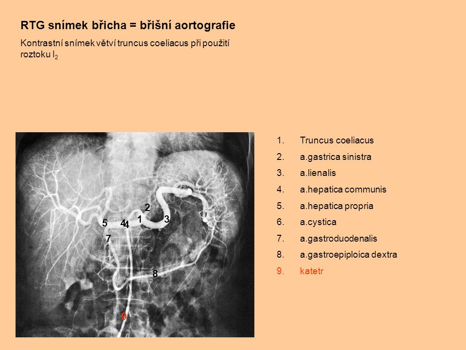 RTG snímek břicha = břišní aortografie