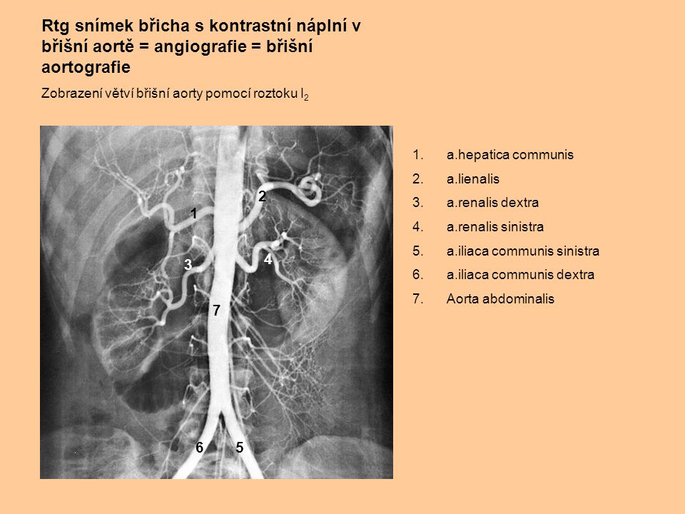 Rtg snímek břicha s kontrastní náplní v břišní aortě = angiografie = břišní aortografie