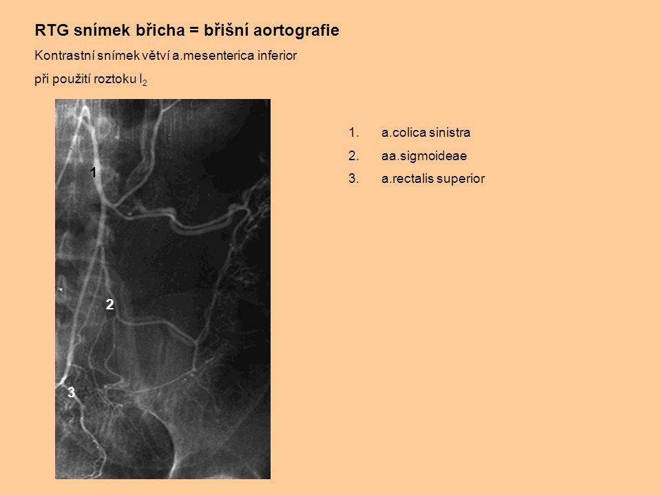 RTG snímek břicha = břišní aortografie