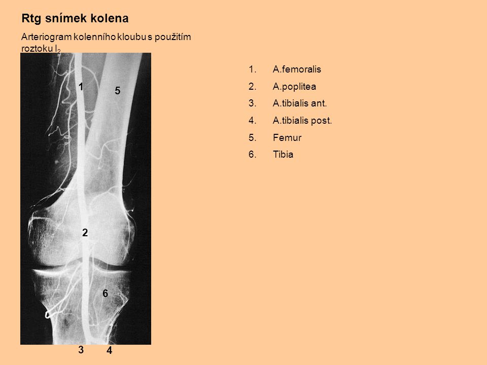 Rtg snímek kolena Arteriogram kolenního kloubu s použitím roztoku I2. A.femoralis. A.poplitea. A.tibialis ant.