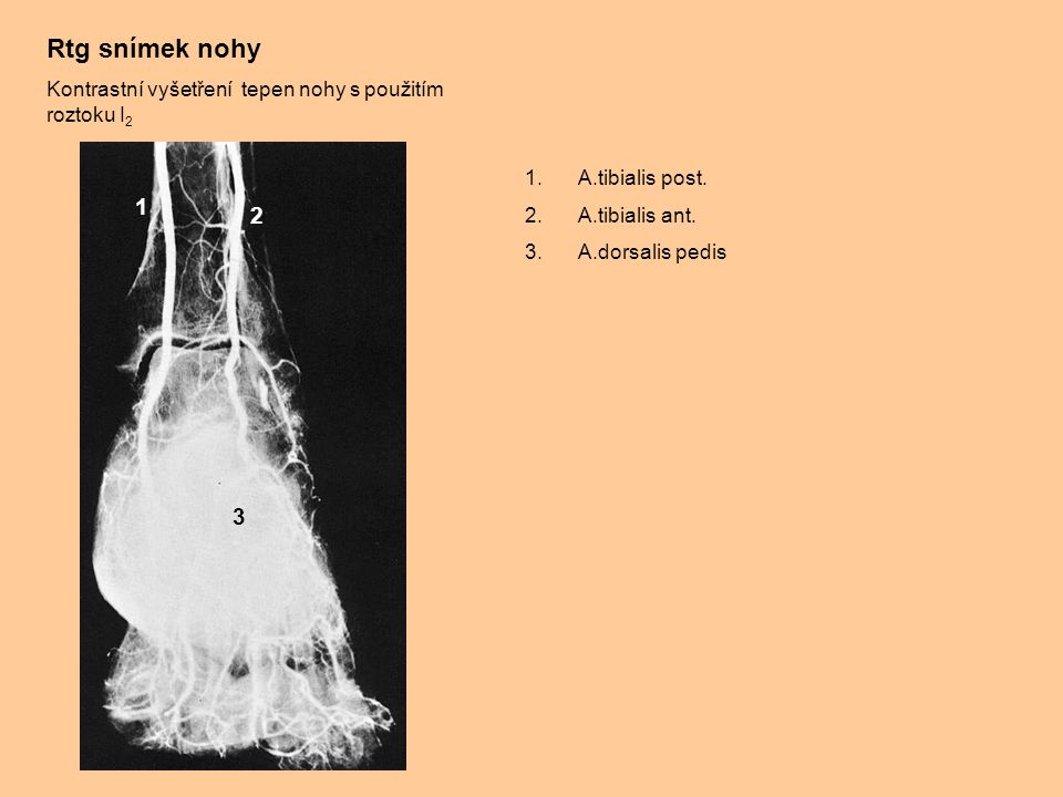 Rtg snímek nohy Kontrastní vyšetření tepen nohy s použitím roztoku I2. A.tibialis post. A.tibialis ant.
