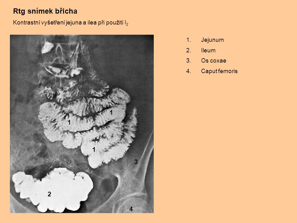 Rtg snímek břicha Kontrastní vyšetření jejuna a ilea při použití I2. Jejunum. Ileum. Os coxae. Caput femoris.