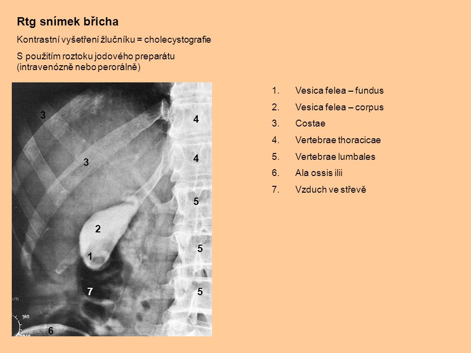 Rtg snímek břicha Kontrastní vyšetření žlučníku = cholecystografie. S použitím roztoku jodového preparátu (intravenózně nebo perorálně)