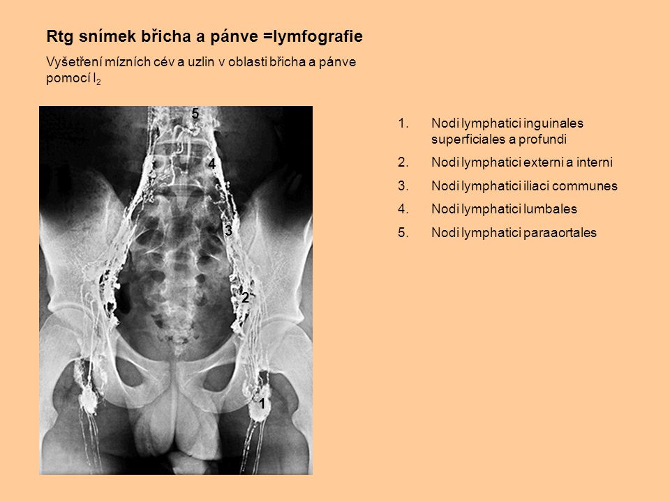 Rtg snímek břicha a pánve =lymfografie
