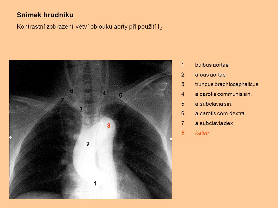 Snímek hrudníku Kontrastní zobrazení větví oblouku aorty při použití I2. bulbus aortae. arcus aortae.