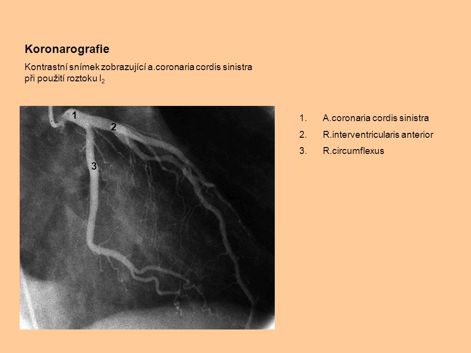 Koronarografie Kontrastní snímek zobrazující a.coronaria cordis sinistra při použití roztoku I2. 1.