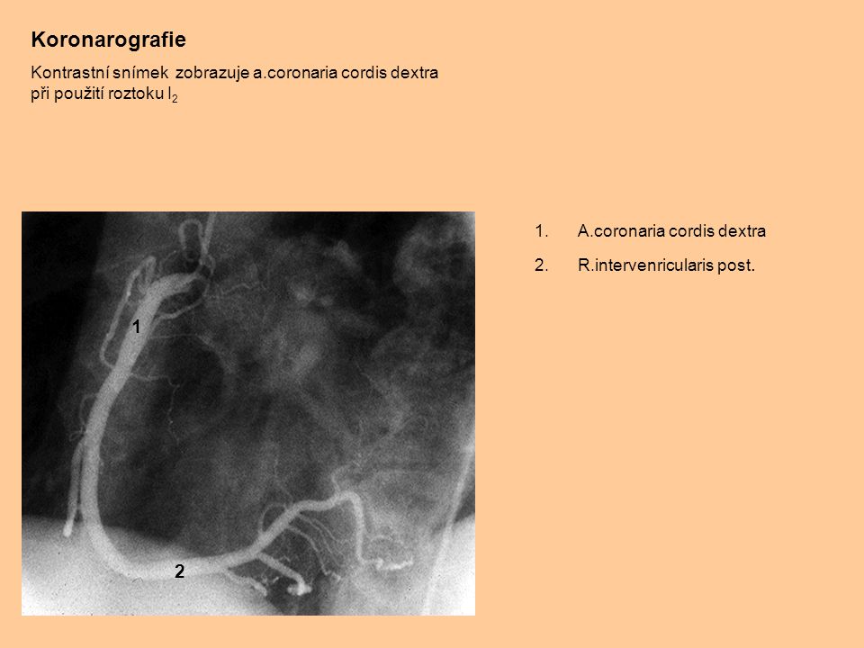 Koronarografie Kontrastní snímek zobrazuje a.coronaria cordis dextra při použití roztoku I2. A.coronaria cordis dextra.