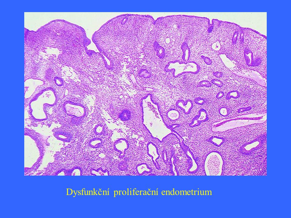Dysfunkční proliferační endometrium