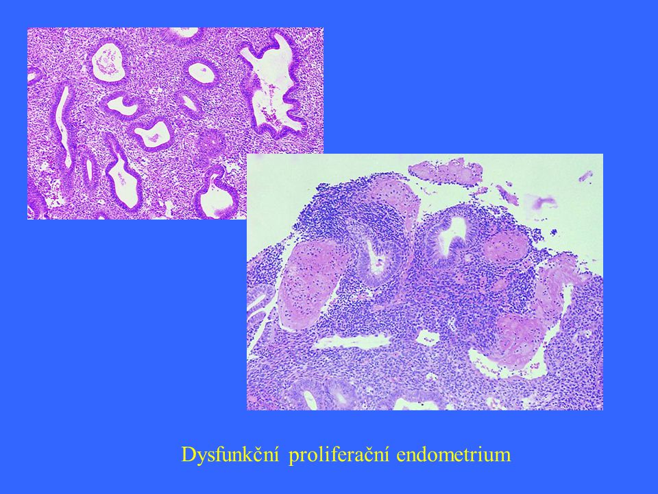 Dysfunkční proliferační endometrium