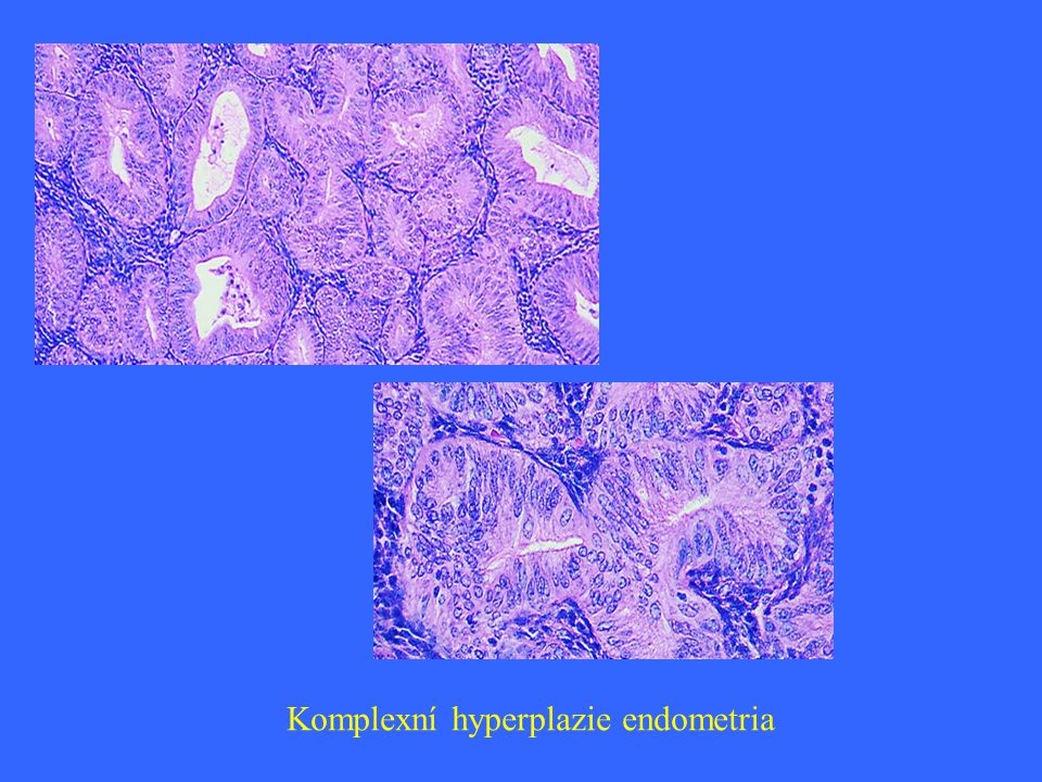 Komplexní hyperplazie endometria