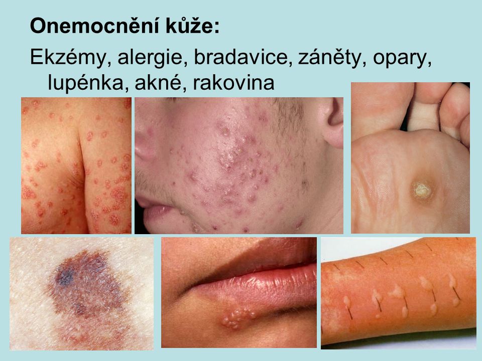 Onemocnění kůže: Ekzémy, alergie, bradavice, záněty, opary, lupénka, akné, rakovina
