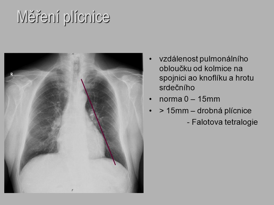 Měření plícnice vzdálenost pulmonálního obloučku od kolmice na spojnici ao knoflíku a hrotu srdečního.