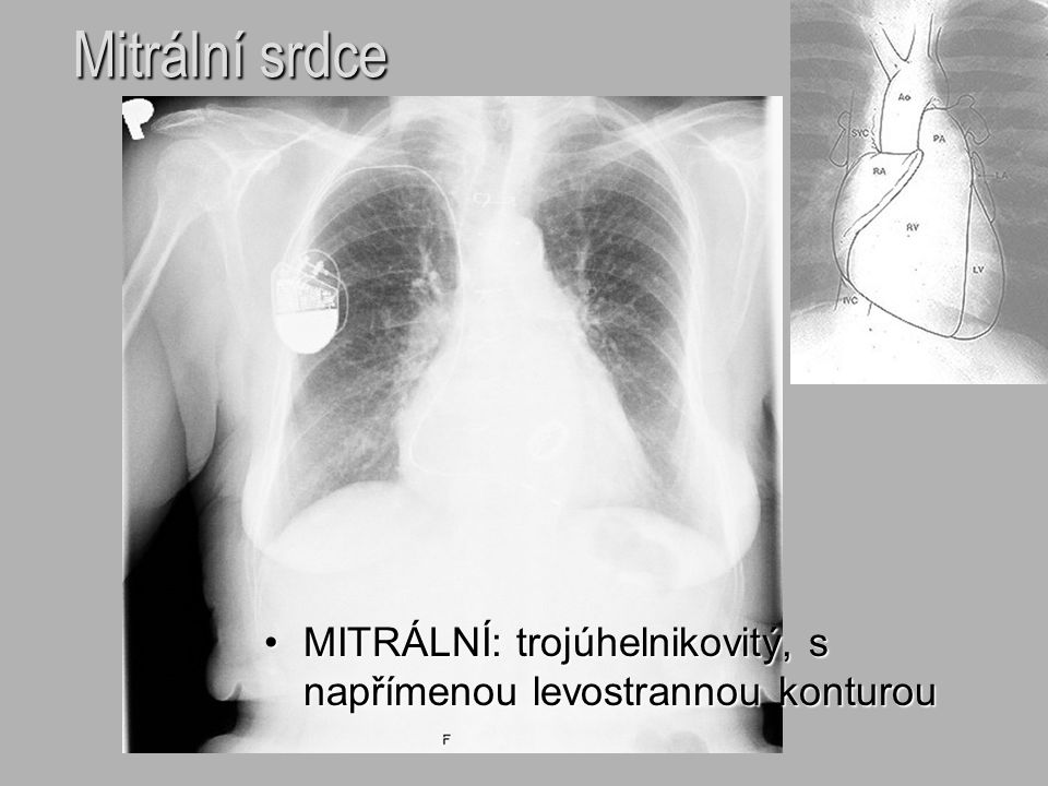 Mitrální srdce MITRÁLNÍ: trojúhelnikovitý, s napřímenou levostrannou konturou