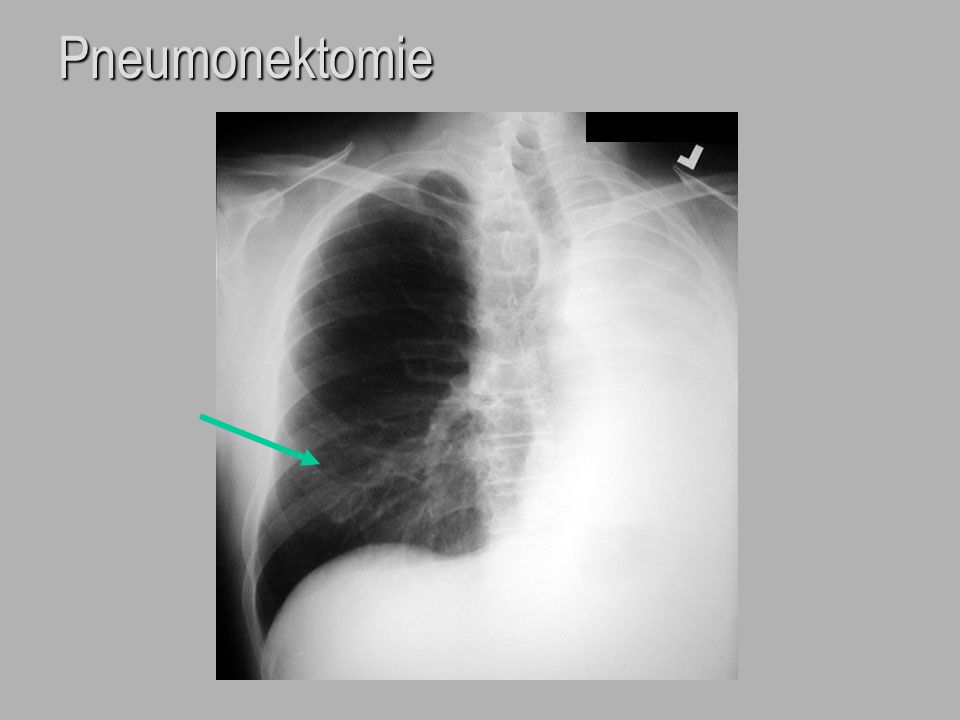 Pneumonektomie
