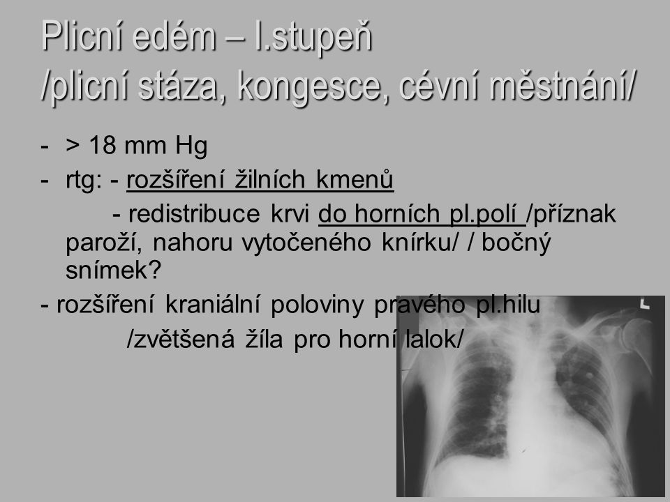 Plicní edém – I.stupeň /plicní stáza, kongesce, cévní městnání/