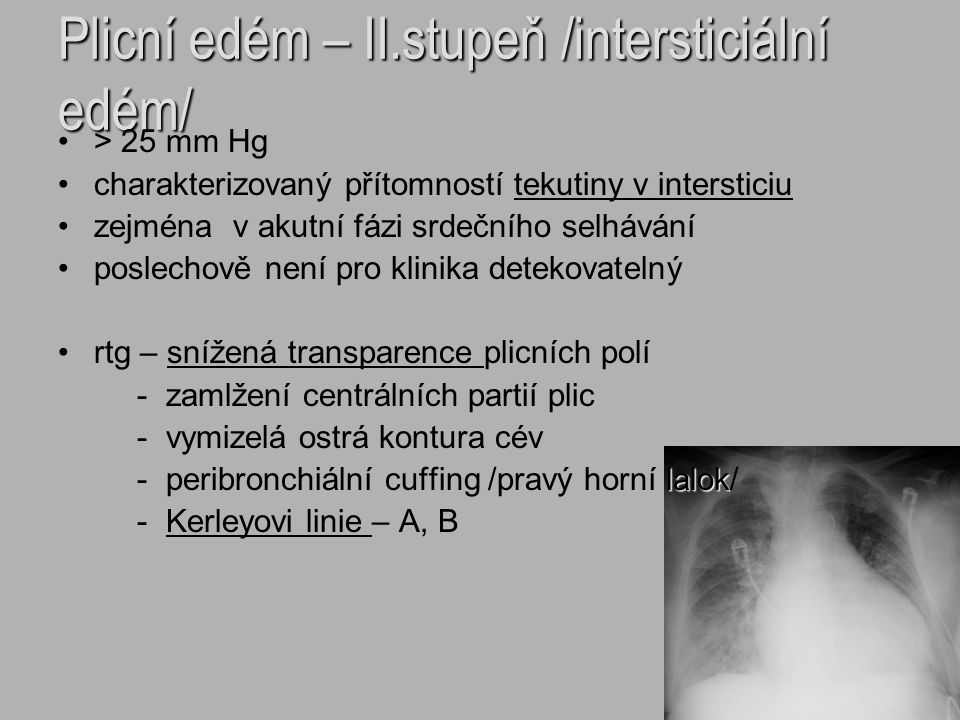 Plicní edém – II.stupeň /intersticiální edém/