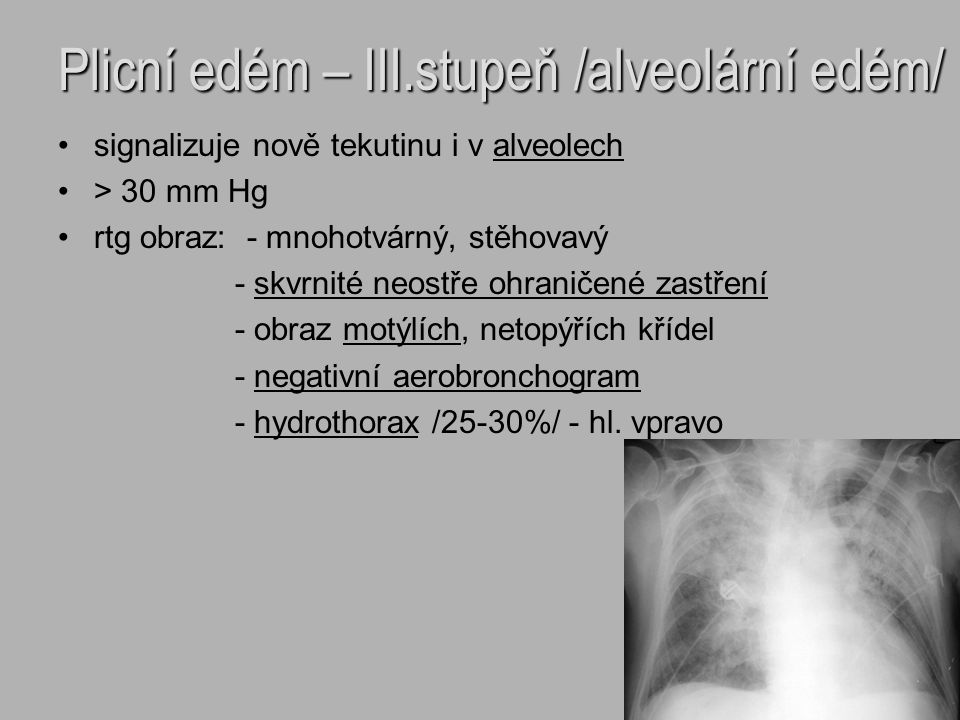Plicní edém – III.stupeň /alveolární edém/