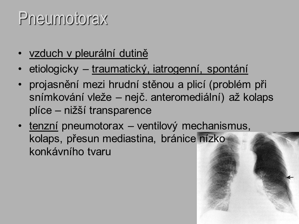 Pneumotorax vzduch v pleurální dutině