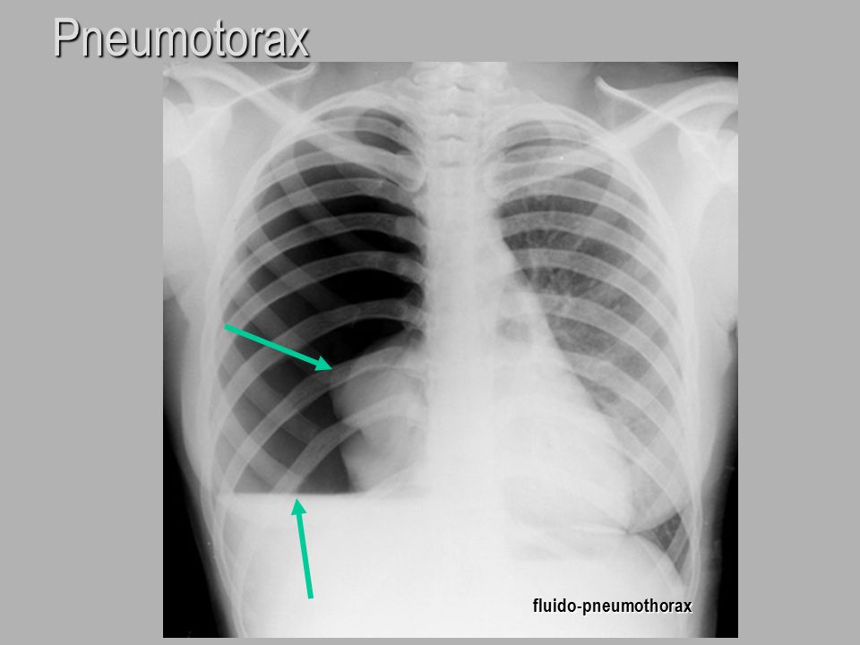 Pneumotorax fluido-pneumothorax