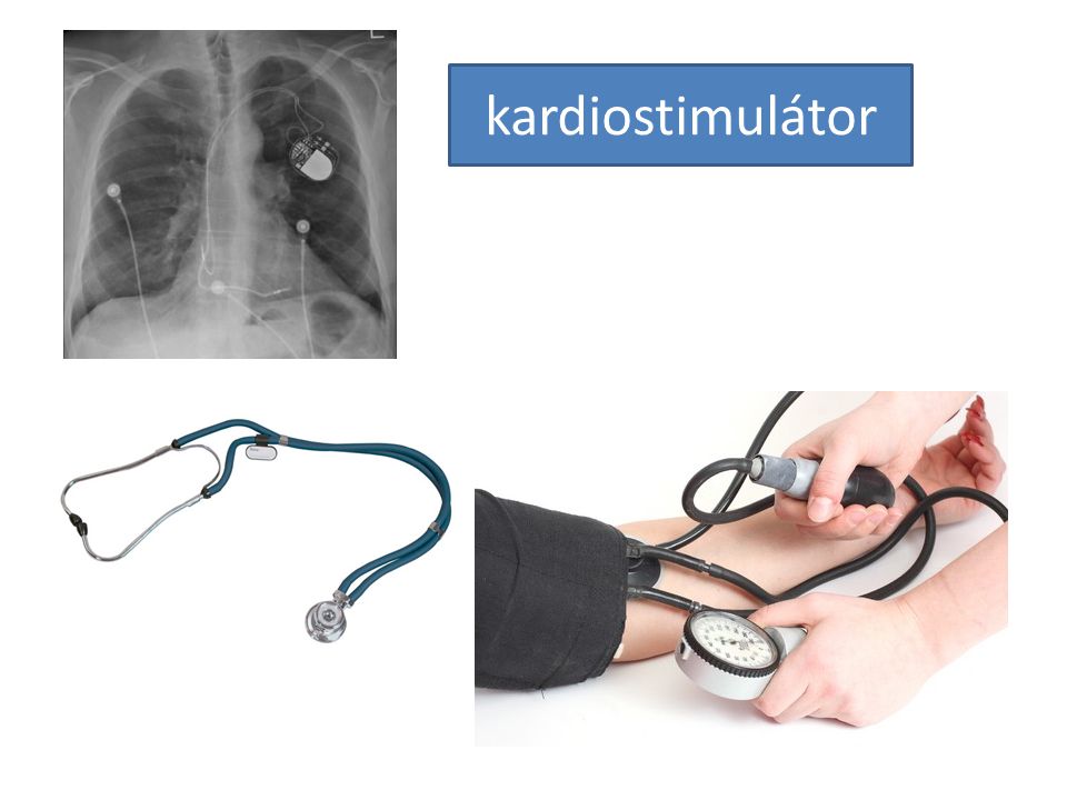 kardiostimulátor